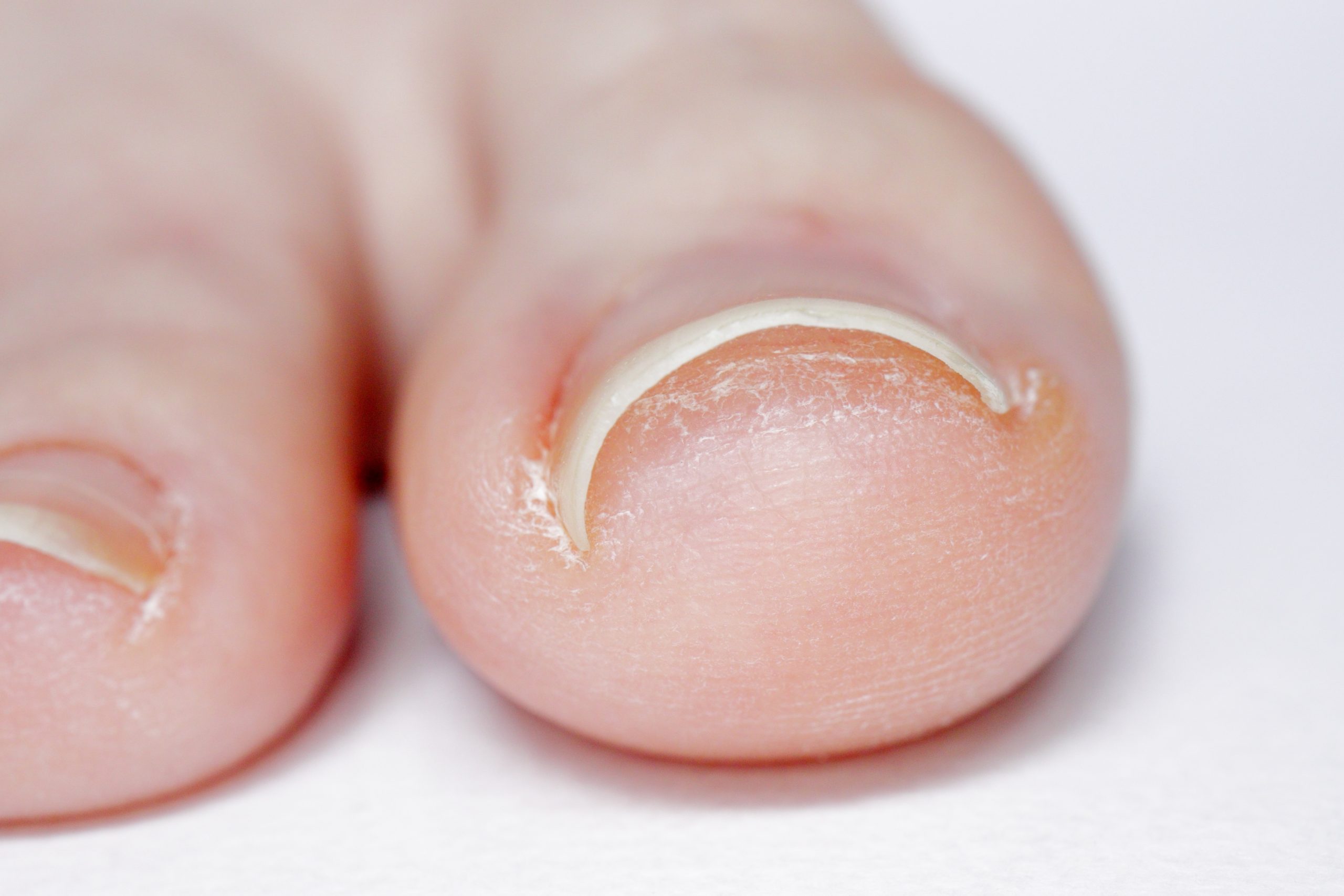 ingrown toenail treatment