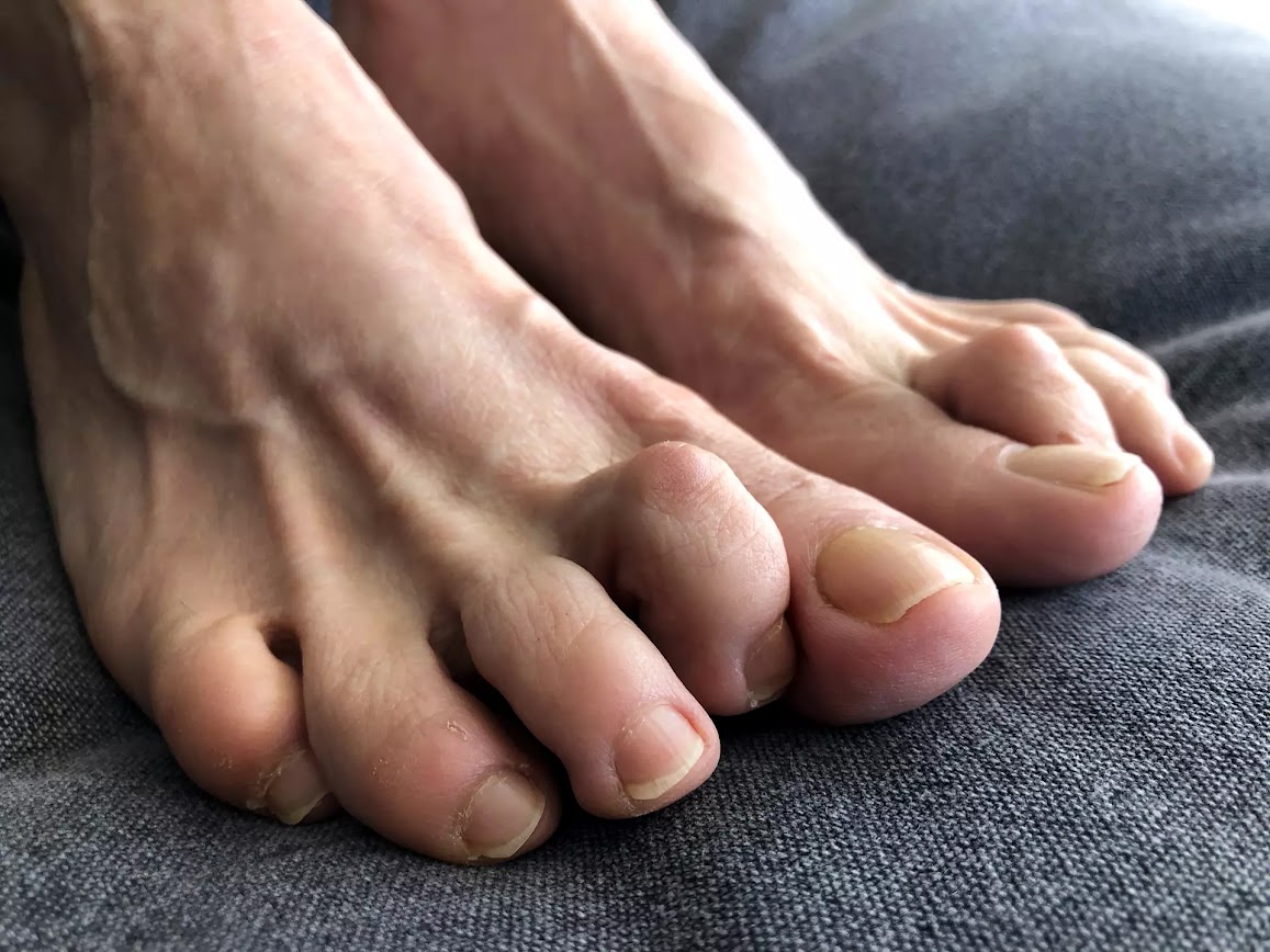 hammertoe correction