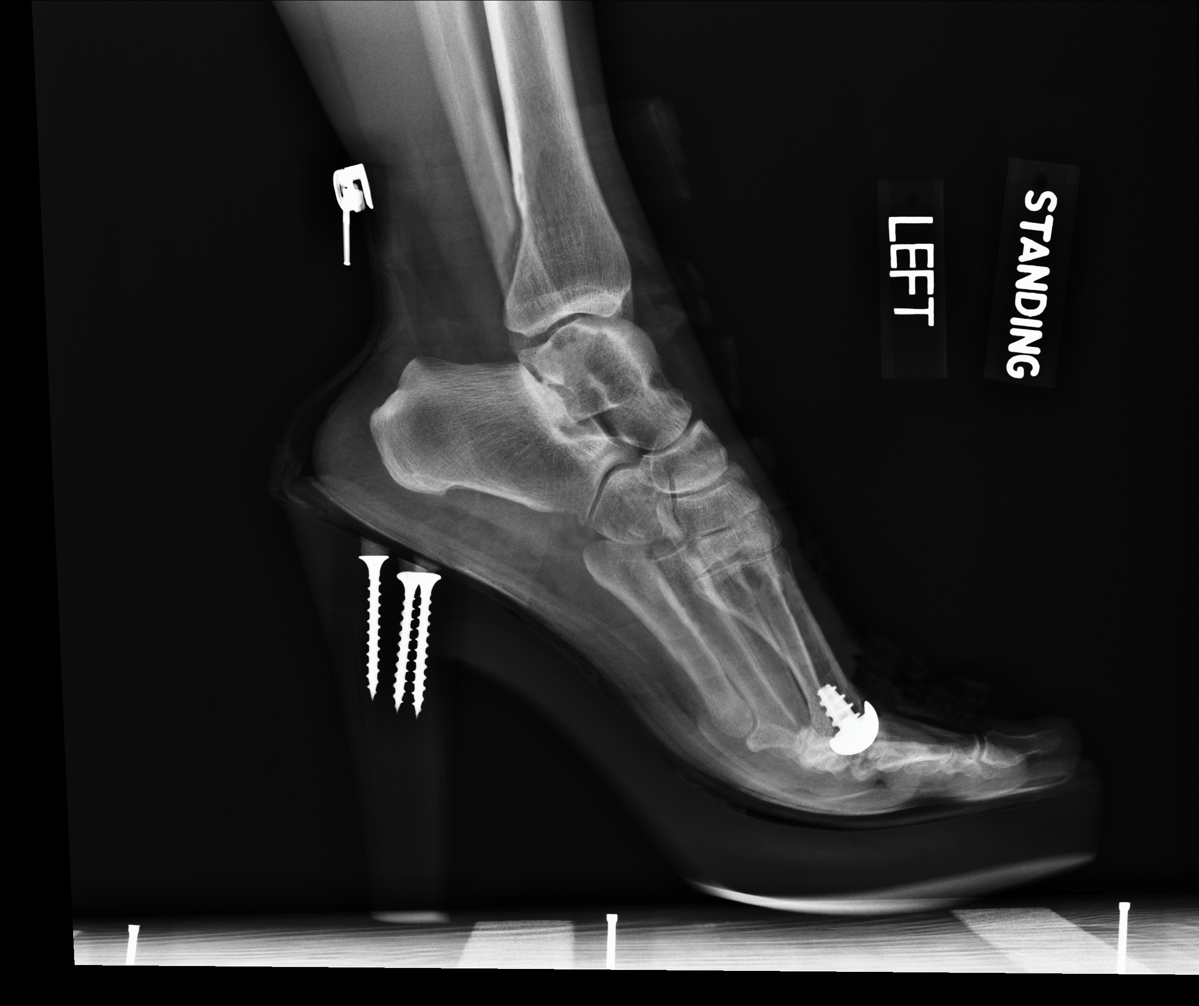 great toe joint replacement