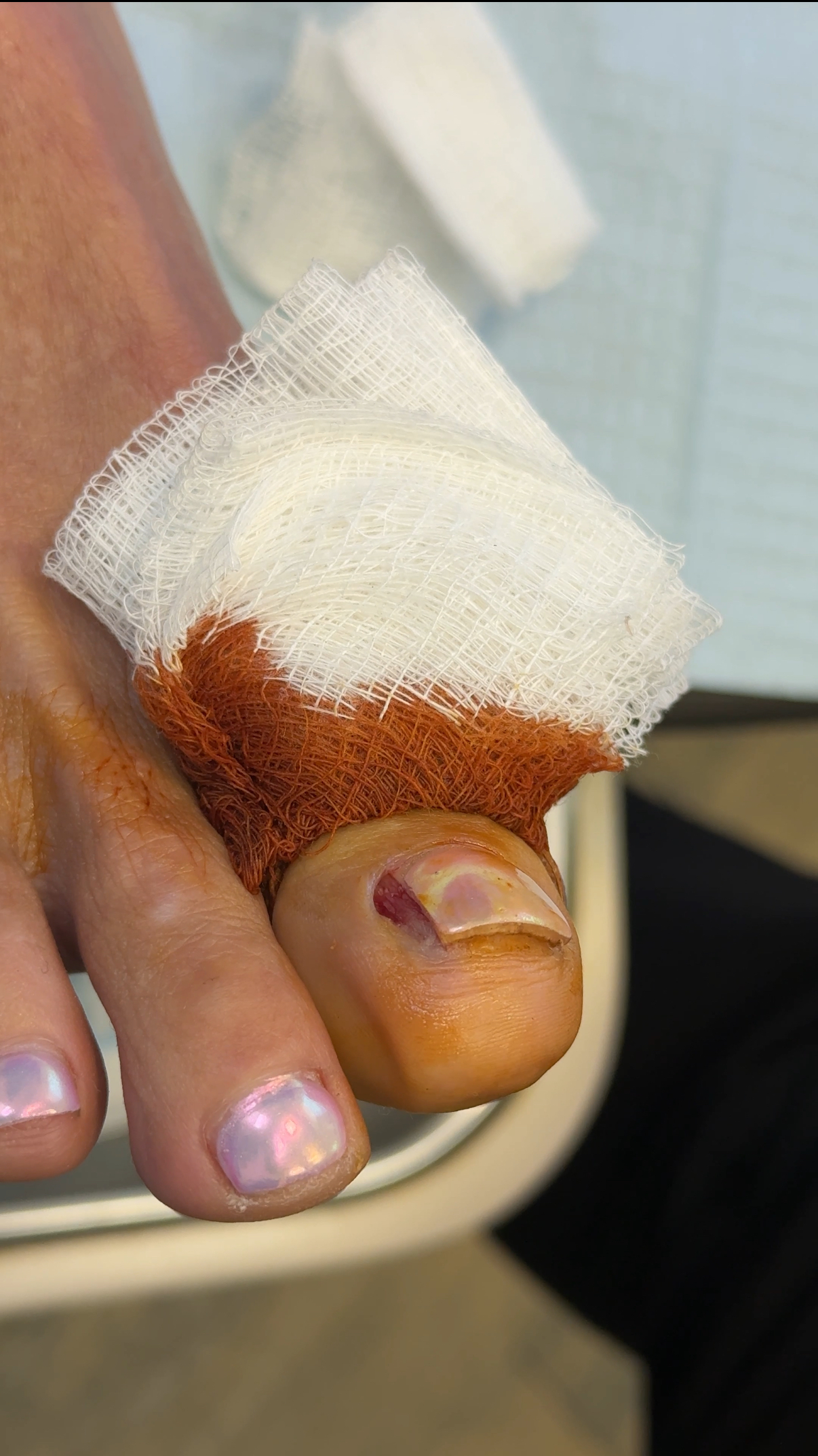 ingrown toenail treatment
